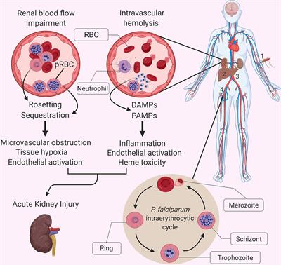 Immunopathology of Acute Kidney Injury in Severe Malaria